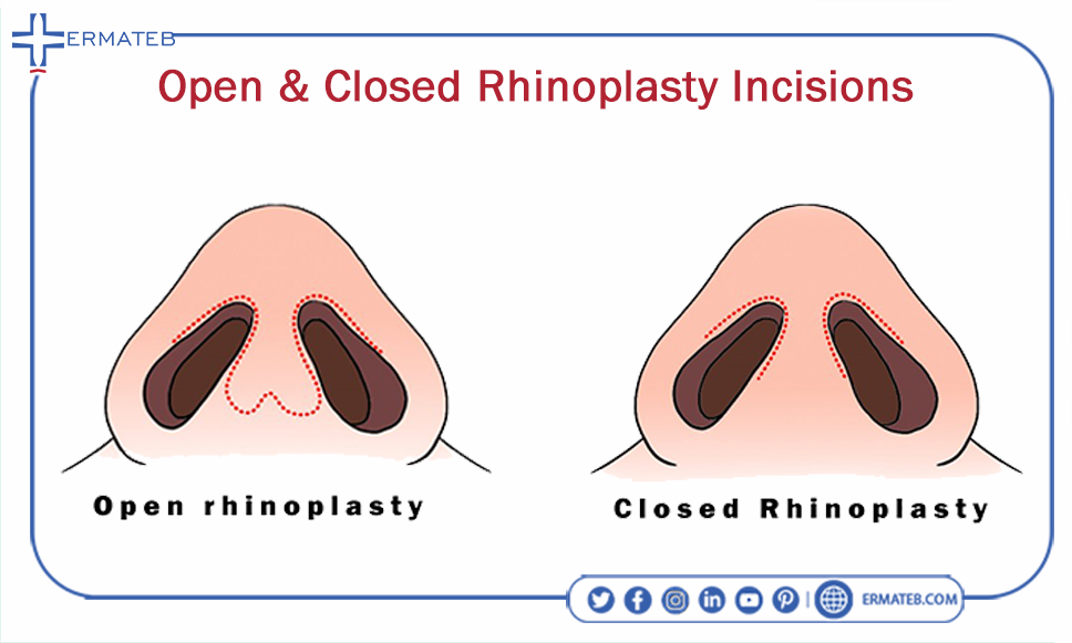 open & closed rhinoplasty incisions